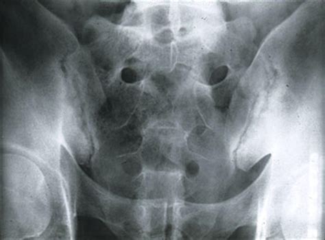 Sacroiliac Joint Inflammation