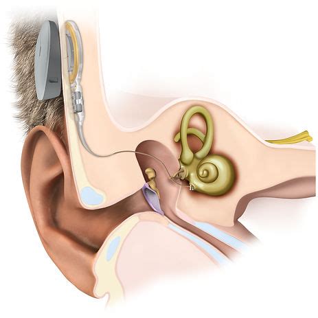 Middle Ear Implants | hellohearing