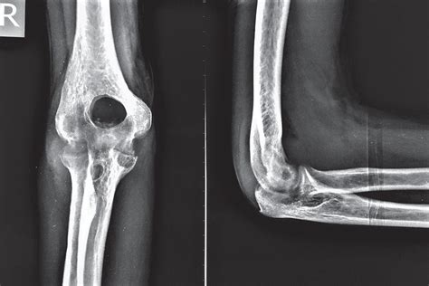 Olecranon Fossa X Ray