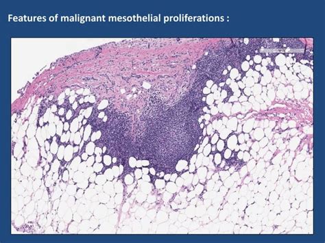 07 histology, cytology and biomarkers in pleural diseases | PPT