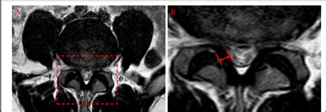 Hypertrophied Ligamentum Flavum Mri : The Radiology Assistant : Lumbar ...