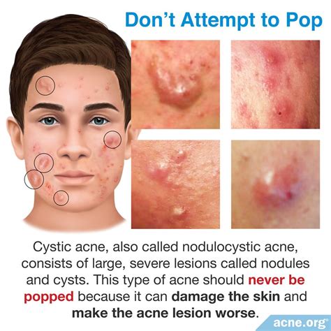 Acne Nodule Vs Cyst