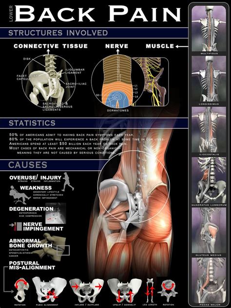 1000+ images about Sciatica & Groin Relief and Pain Patterns on Pinterest | Lower backs, Back ...