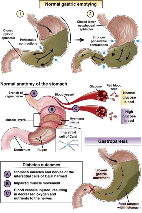 Diabetic gastroparesis - AGA GI Patient Center