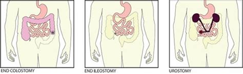 Colostomy, ileostomy, and urostomy