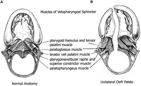 Velopharyngeal insufficiency in patients with cleft palate - Oral and Maxillofacial Surgery Clinics