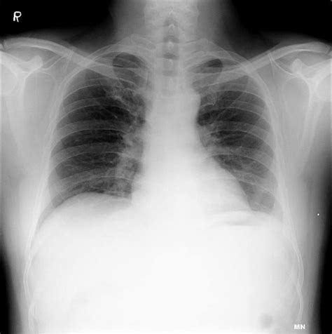 Image guided biopsy of the pleura: a useful diagnostic tool even when fluid is minimal | BMJ ...