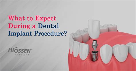 What to Expect During a Dental Implant Procedure | Hiossen