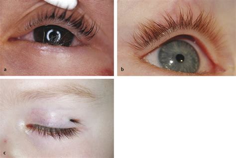 Normal Eyelashes Vs Distichiasis