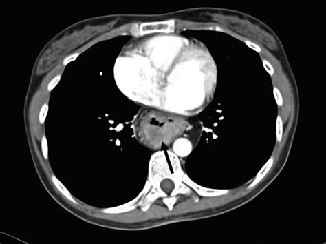 Tomografía computarizada de tórax que demuestra masa intraluminal en ...