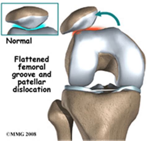 Video: Patellar Dislocation and Surgical Decision Making – Howard J. Luks, MD