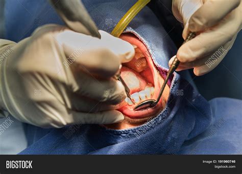 Root Canal Surgery Image & Photo (Free Trial) | Bigstock