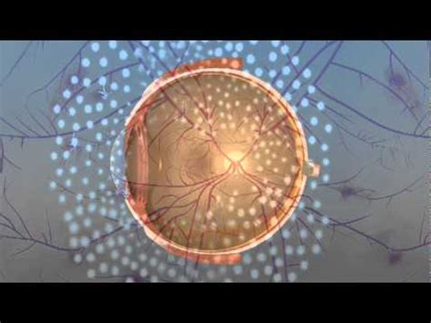 Vitrectomy Surgery for Diabetic Retinopathy - YouTube