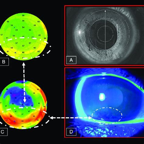 (PDF) Main Feature OCT and dry eye syndrome