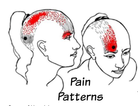 Occipital Nerve Stimulator Occipital Occipital Neuralgia Nerve Anatomy ...