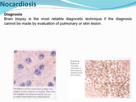 Cns infections Lecture