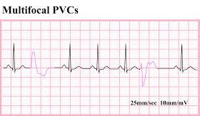 Ventricular Ectopics | Cardiac nursing, Ekg rhythms, Ekg