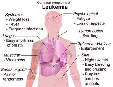 Diagram Of Blood Cancer Symptoms Image - Graph Diagram