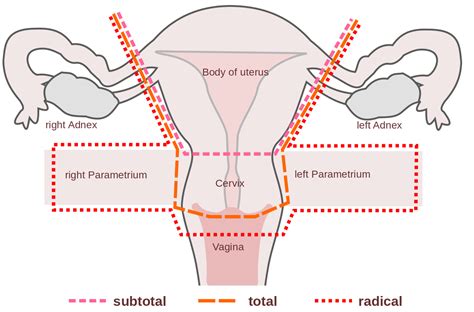 Hysterectomy - Procedure - Indications - Complications - TeachMeObGyn