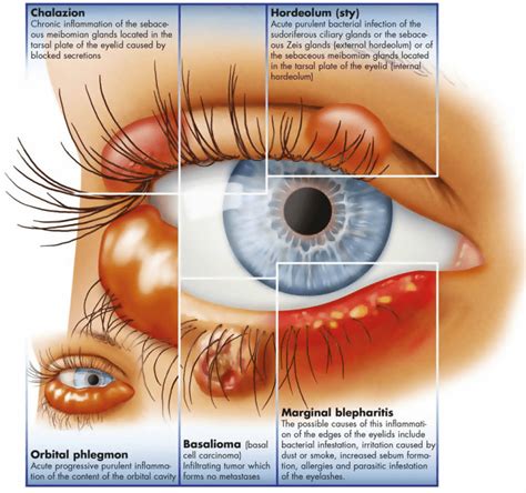 Chalazion vs hordeolum usmle, Chalazion Procedures: Overview ...