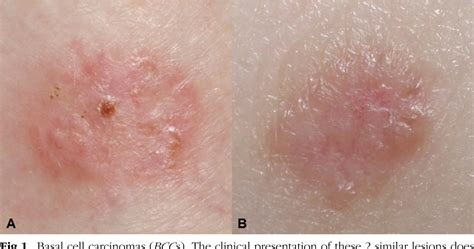 Figure 1 from Accuracy of dermoscopic criteria for discriminating superficial from other ...