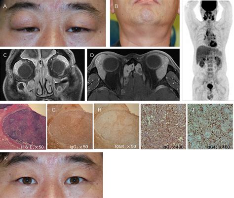 IgG4-related disease in idiopathic sclerosing orbital inflammation | British Journal of ...