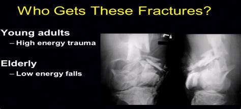 Tips and Tricks in Distal Femur fractures — OrthopaedicPrinciples.com