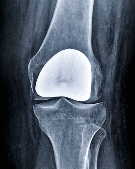 Patellofemoral Arthroplasty – ADAM SASSOON M.D., M.S.