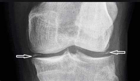 Chondrocalcinosis Shoulder