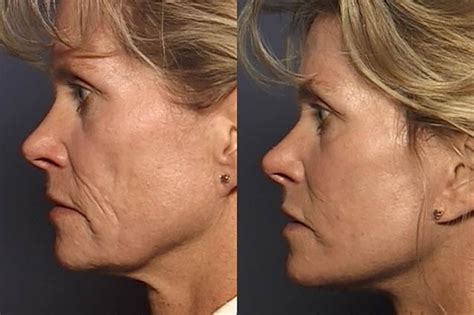 Lower-Face Rejuvenation Patient Photos | Champaign-Urbana