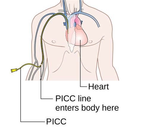 Complications and Care of Peripherally Inserted Central Catheters (PICC) Line | New Health Advisor