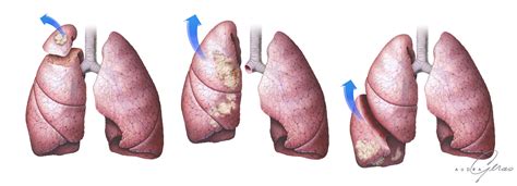 Lung Cancer Surgeries - Geras Healthcare Productions