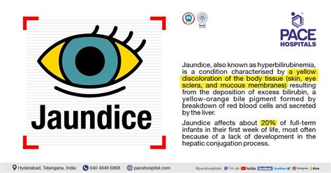 Jaundice Disease - Symptoms, Causes, Complications and Prevention