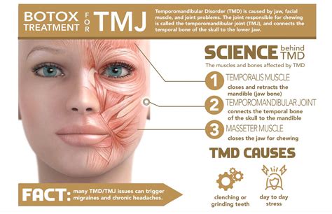 Botox for TMJ and Migraines | Highly Effective | - BEAUX MEDSPA