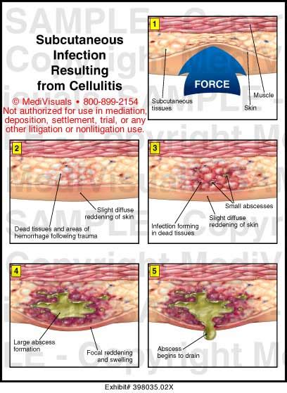 Medivisuals Subcutaneous Infection Resulting from Cellulitis Medical Illustration