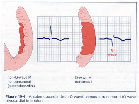 PPT - ECG Changes in Acute Myocardial Infarction PowerPoint Presentation - ID:393097