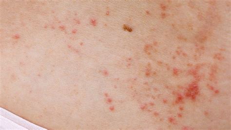 Red spots on the skin: main causes of the problem | Nxt Health