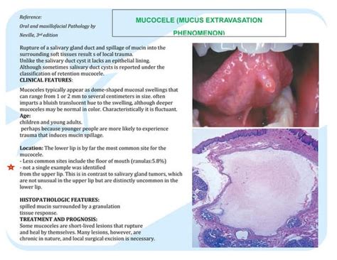 Efficacy of polidocanol sclerotherapy in mucocele of the