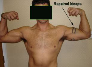 Bicep Tendon Rupture - ElbowDoc