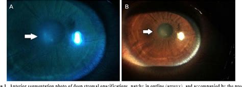 Figure 1 from A Case of Acute Interstitial Keratitis in a Patient with ...