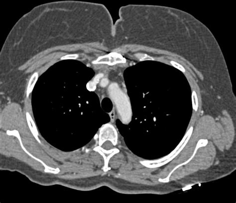 Patent Stent in the Superior Vena Cava (SVC) - Chest Case Studies - CTisus CT Scanning