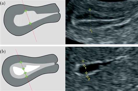 Terms, definitions and measurements to describe the sonographic features of the endometrium and ...