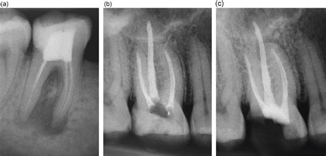 Removal of Root Canal Filling Materials | Pocket Dentistry