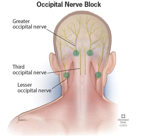 Occipital Nerve Block: What It Is, Procedure & Side Effects