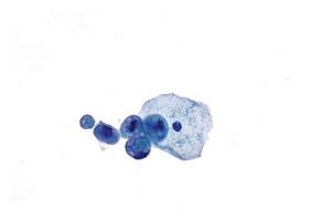 Urine cytopathology - Libre Pathology