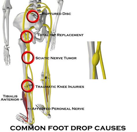 Treating with Foot Drop - Almawi Limited The Holistic Clinic