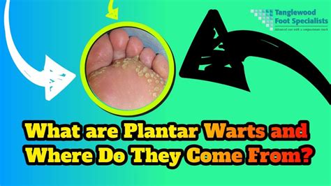 Houston Plantar Wart Removal Specialist | Tanglewood Foot Specialists