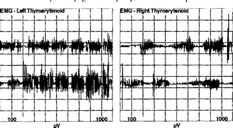 Figure 2 from Chronic Cough as a Sign of Laryngeal Sensory Neuropathy ...