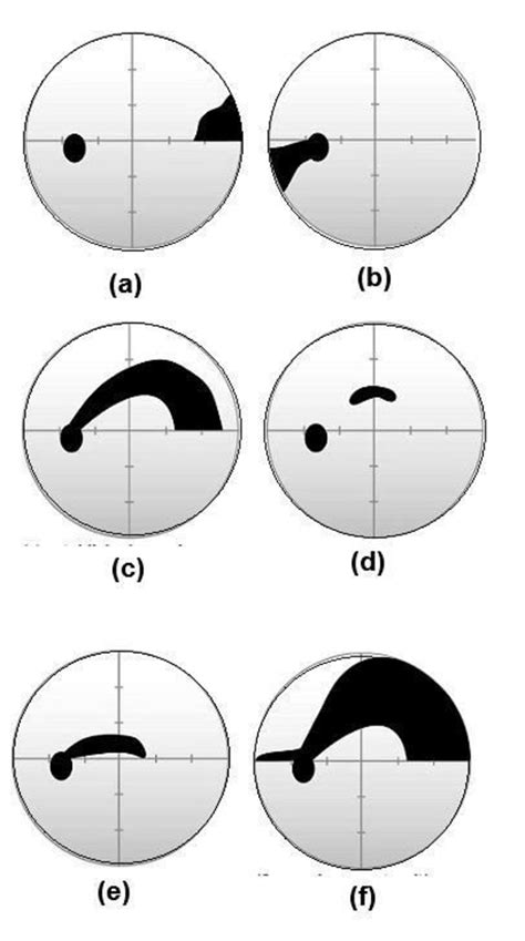 Nasal Visual Field Defect