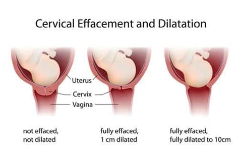 Cervix Dilation Chart Labor